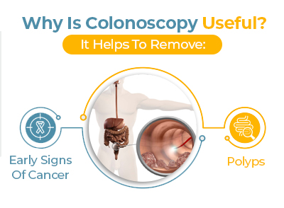 Colonoscopy-2