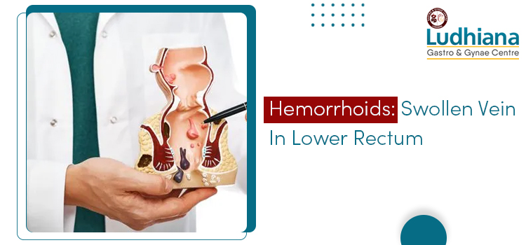 Hemorrhoids Swollen Vein In Lower Rectum