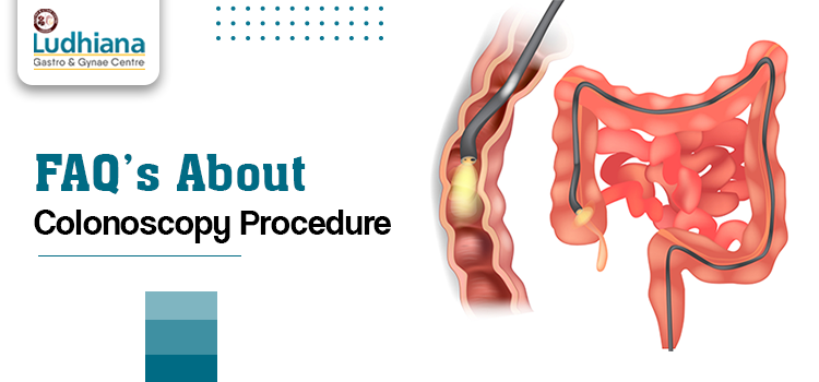 Faqs About Colonoscopy Procedure